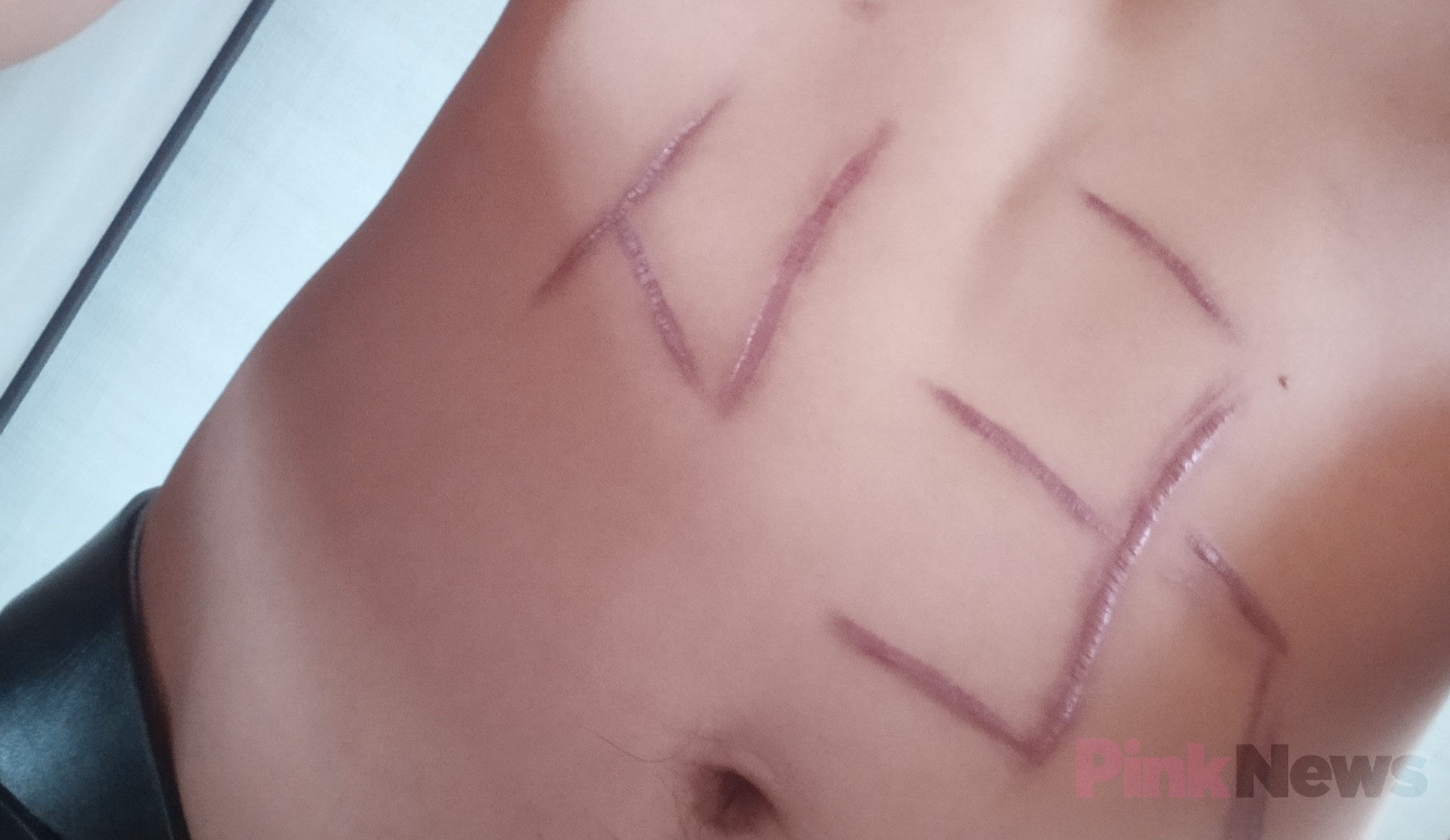 Kyrgyzstan man has 'gay' carved into stomach in homophobic attack