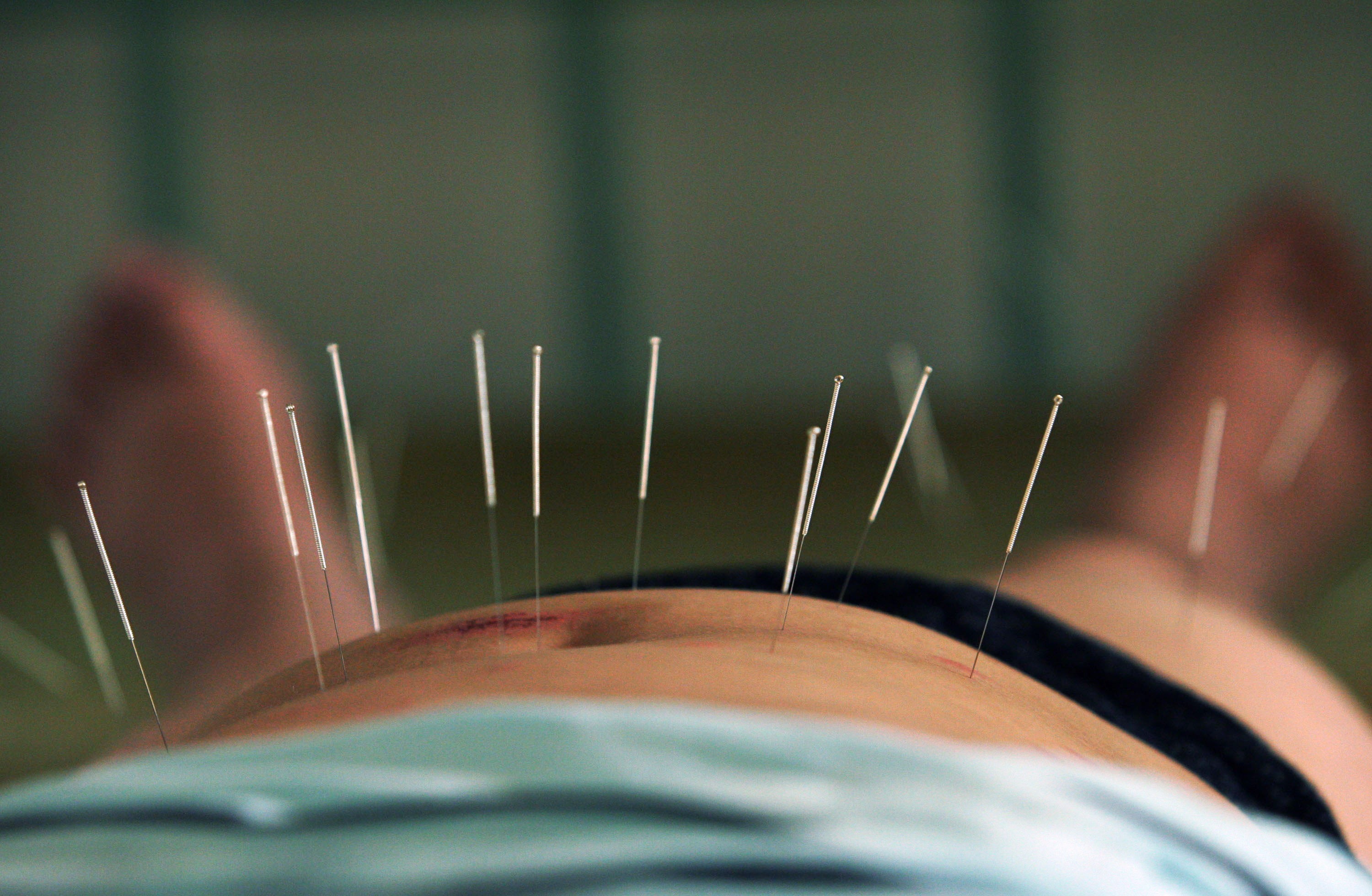 Apparently, acupuncture can 'cure' homosexuality