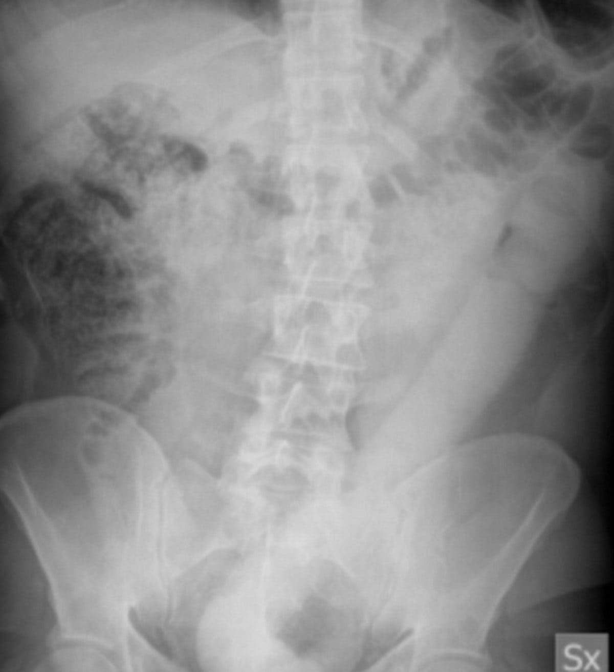 Doctors invent new tool to 'lasso' 23-inch dildo out of man's rectum