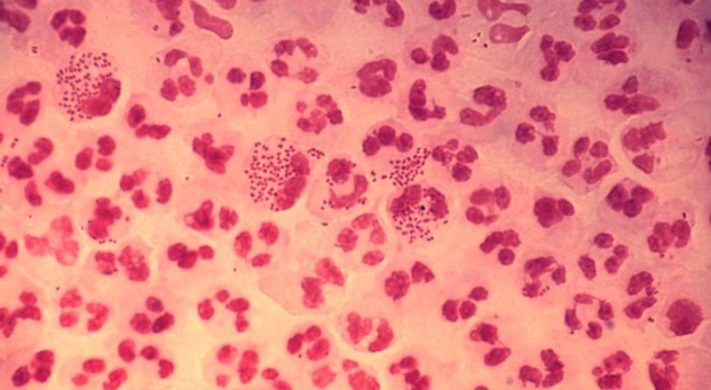 Health officials have 'huge concerns' as 'super strain' of gonorrhoea spreads to gay and bi men