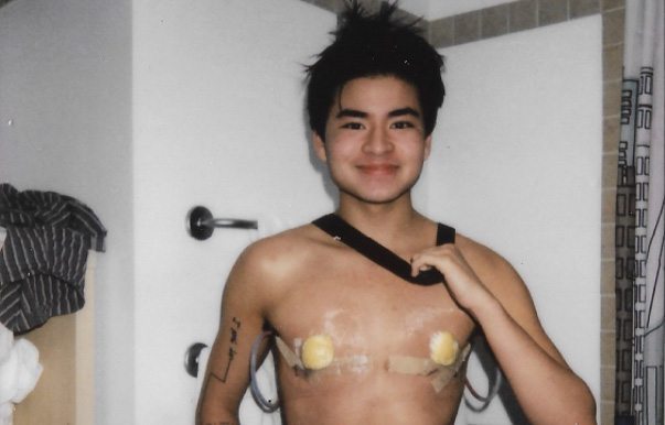 This trans man's tweet about his top surgery is going viral for all the right reasons