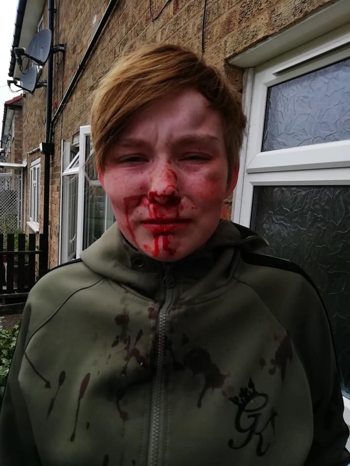 An 18-year-old girl with blood down her face