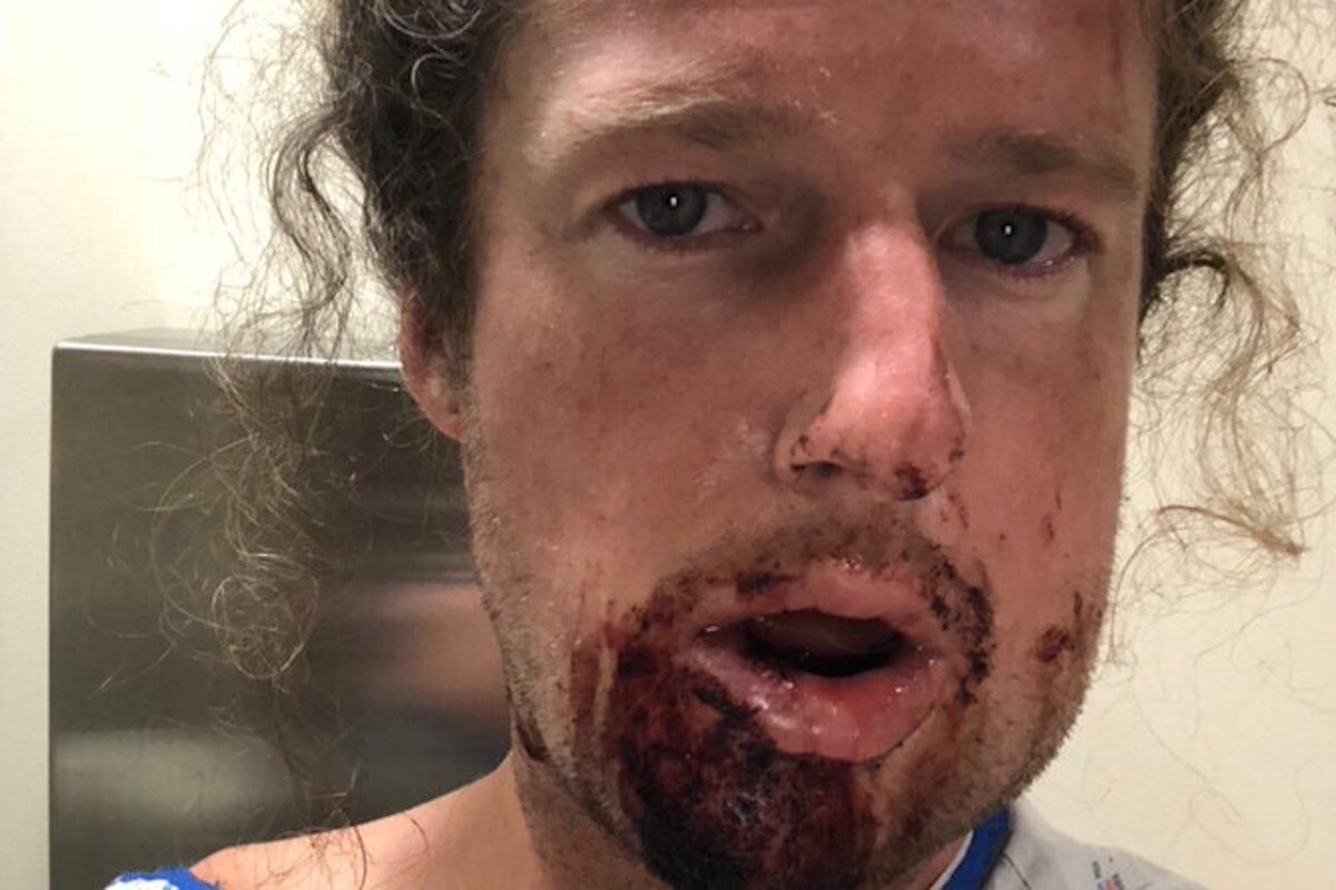 Homeless trans woman 'could need reconstructive surgery' after alleged hate crime