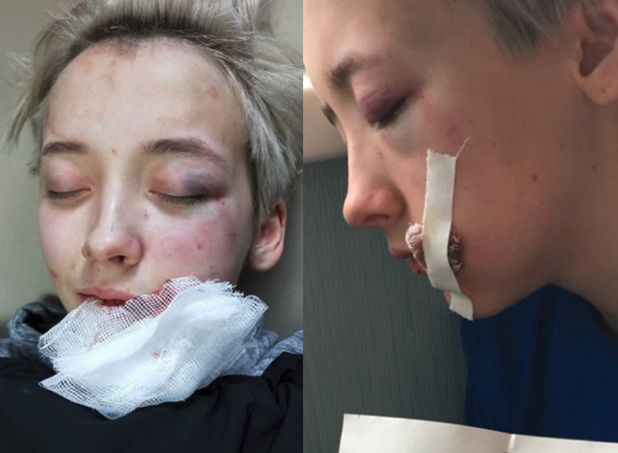 Teenage girl hospitalised with severe injuries after being brutally beaten by gang of men in 'homophobic' attack