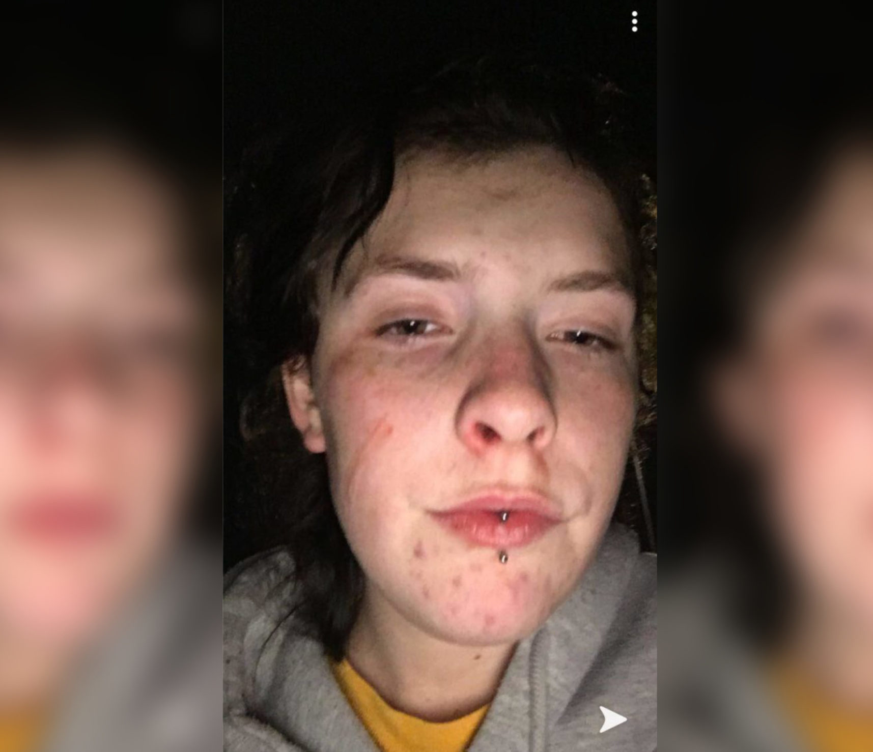 Queer 16-year-old viciously beaten by thugs in vile homophobic attack, leaving her bleeding and covered in bruises