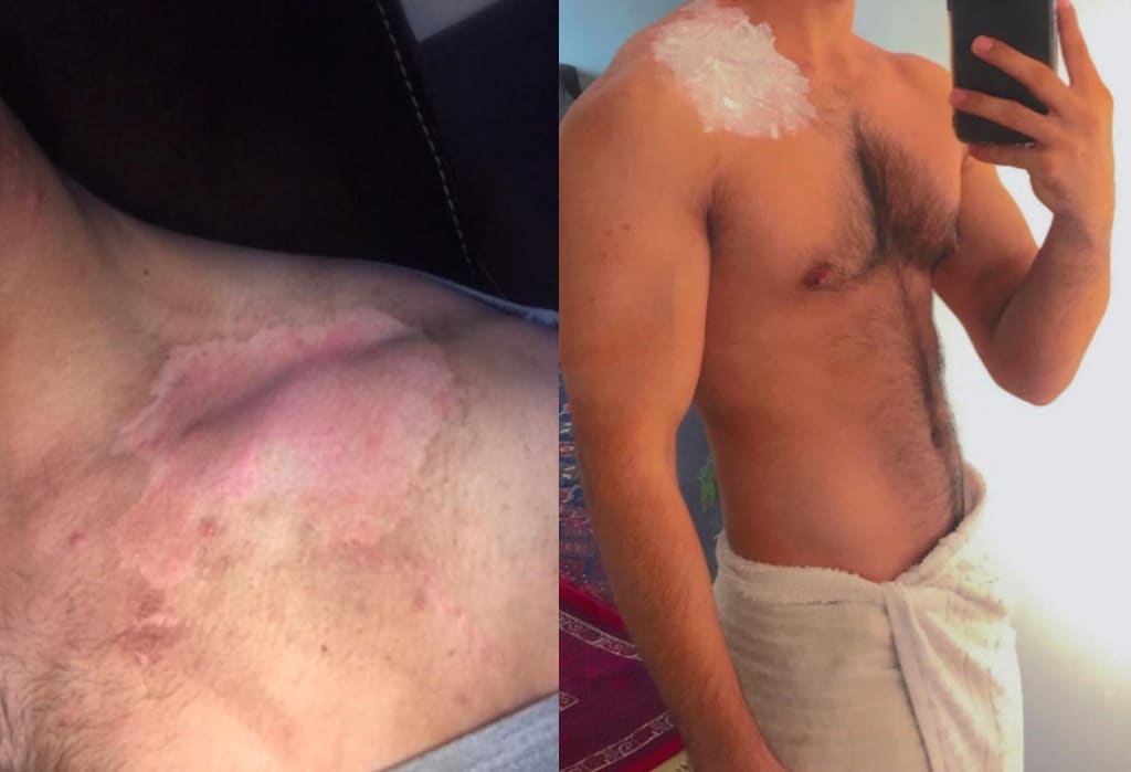 Sohil Afghanistan burn