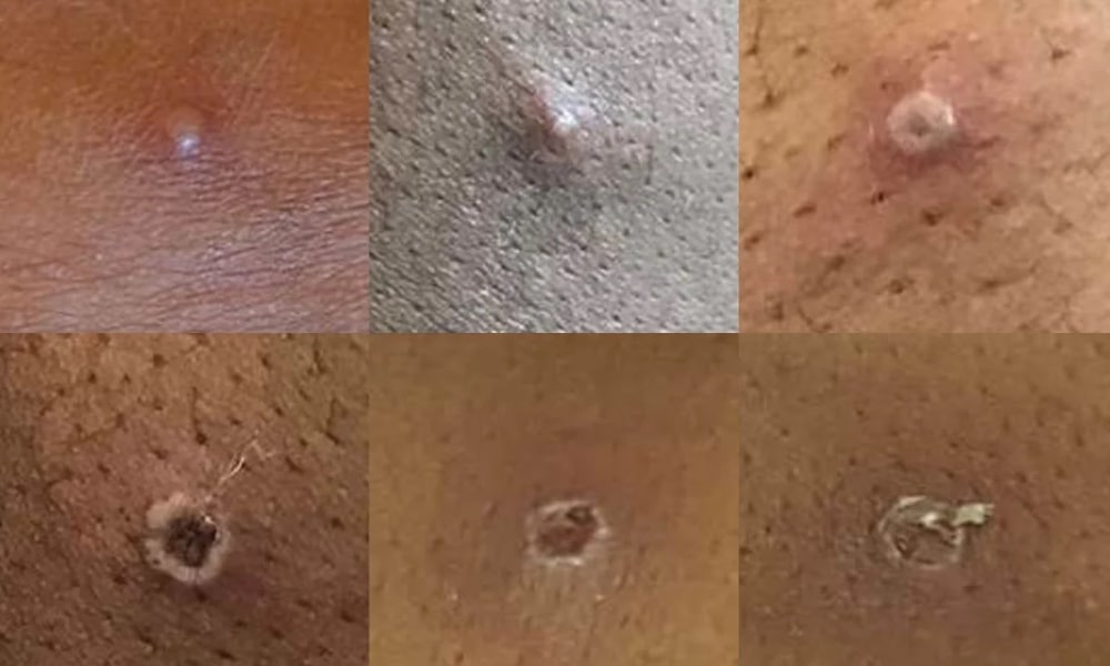 Monkeypox outbreak 'is containable' says World Health Organization