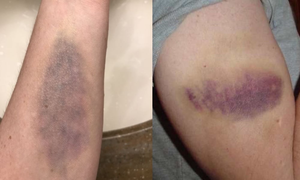 Gay Afghan who fled after being abducted, beaten and burned by Taliban left in asylum limbo