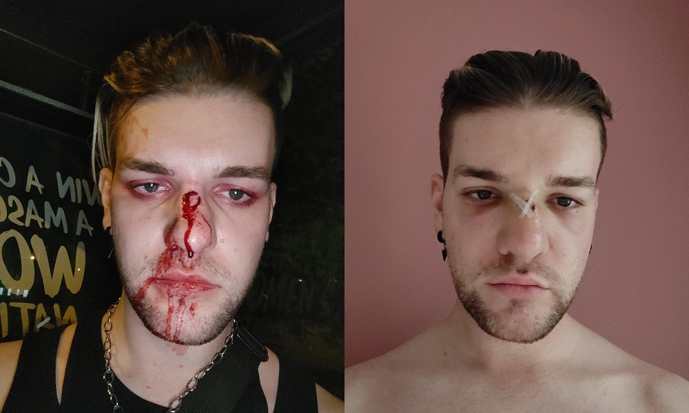 Gay man's birthday celebrations end with him being brutally beaten on a bus: 'Justice will happen'