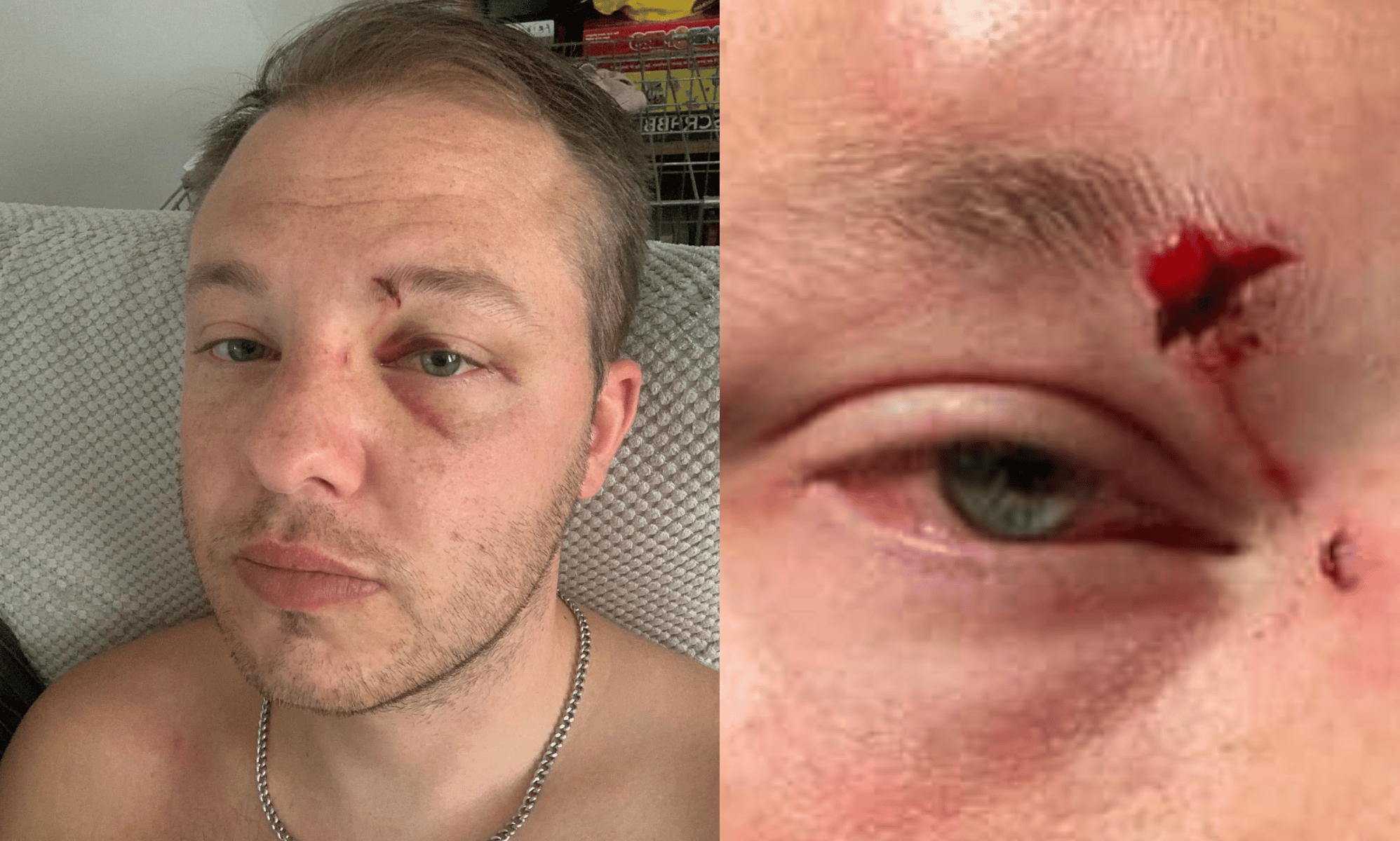 Gay man told to 'know his place' after homophobic attack left him with permanent scar