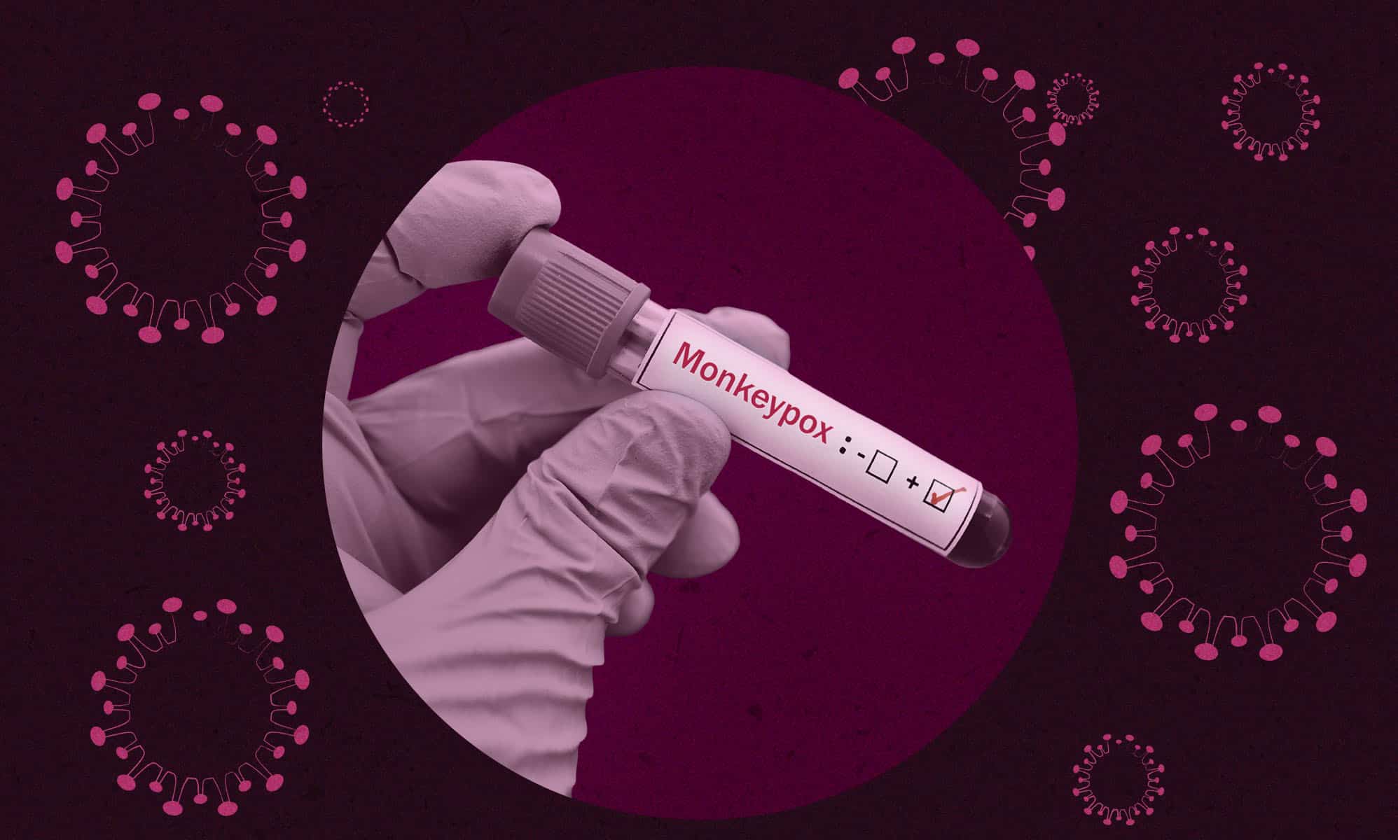 Monkeypox: US confirms first death caused by virus