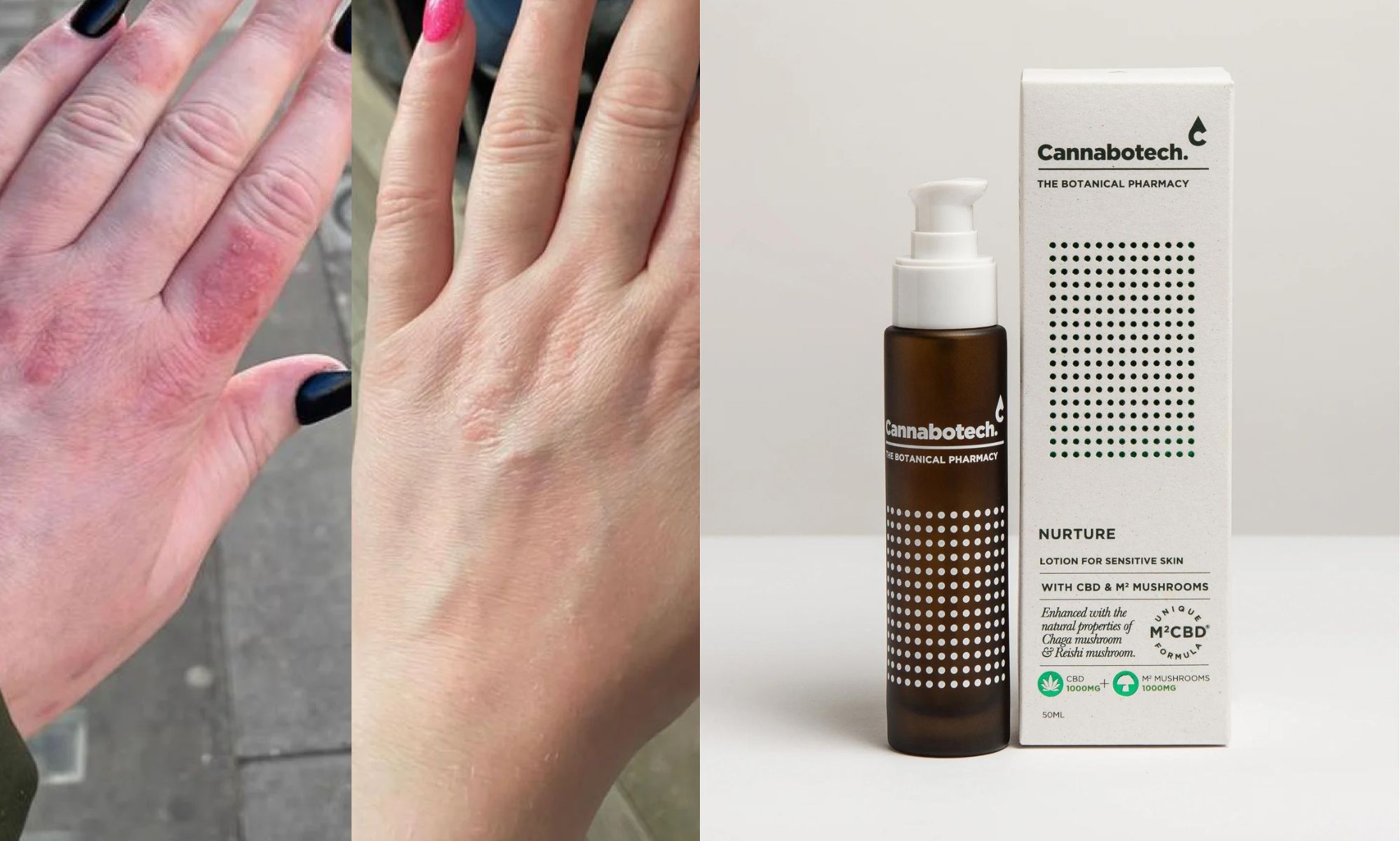 This skincare's hero ingredient duo is helping psoriasis sufferers
