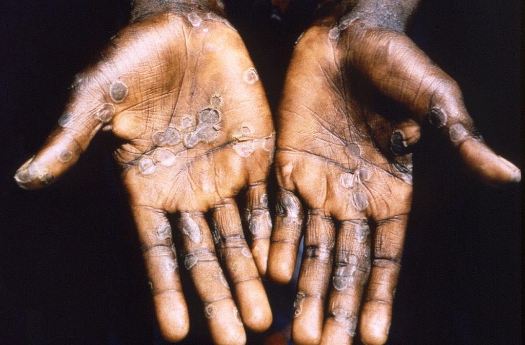 Ongoing Mpox outbreak declared a public health emergency and 'global threat' by Africa CDC