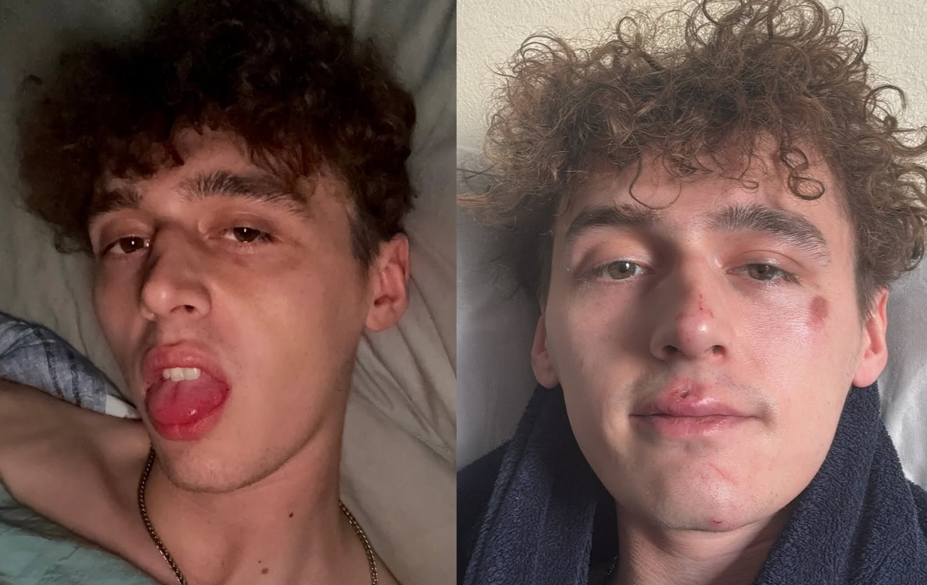 Big Brother winner Cameron Cole left with a black eye and facial injuries after homophobic attack